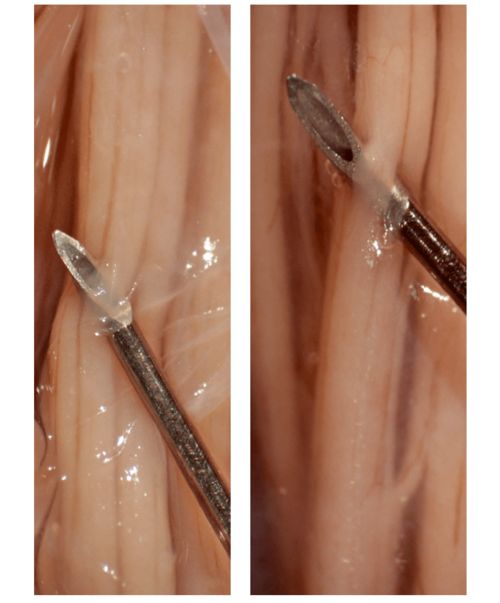 美图收藏贴 椎管内解剖及针头的结构解读